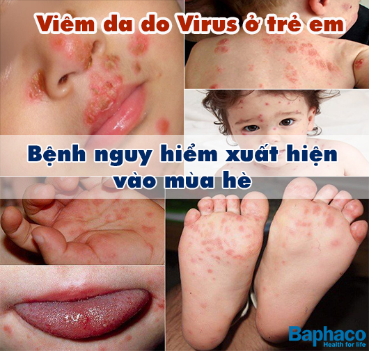 Viêm da do Virus ở trẻ em- bệnh nguy hiểm xuất hiện vào mùa hè