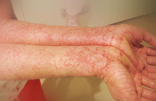 thuốc nào trị bệnh eczema